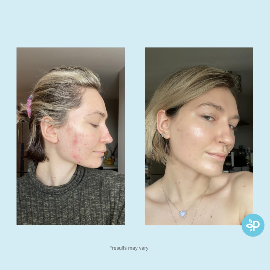 Hydro-Glo Peel Pads - Enhanced with Kojic, Mandelic, Glutathione, Licorice, Papaya, Pineapple, Bearberry Extracts (10% Strength Peel)-FemmiqueWomen