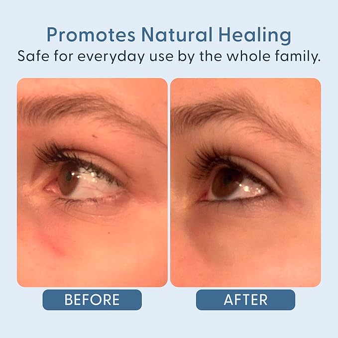 twenty/twenty Easy On The Eyes – 0.02% Hypochlorous Acid Spray to Cleanse Eyelashes – Reduce Eyelid Irritation – Safe for Sensitive Skin – Ophthalmologist Developed–Vegan, Clean Ingredients – 60ml-FemmiqueWomen