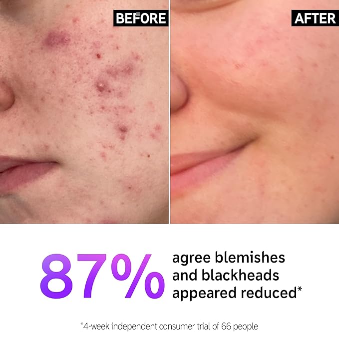 The INKEY List Salicylic Acid Cleanser, Face Wash for Blemishes, Blackheads, Oily Skin and Breakouts, Non-Drying Facial Cleanser Safe for All Skin Types, 5.0 fl oz-FemmiqueWomen