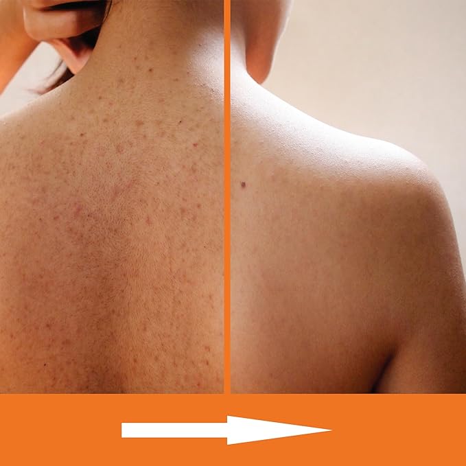 Salicylic Acid Body Wash - Skin Non-drying, Gentle Exfoliates Rough and Bumpy Skin, Body Acne Wash, BHA & AHA - Unscented Exfoliating Body Wash, Made in USA - (16 fl oz x 2)-FemmiqueWomen