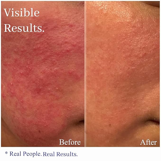 Hey Honey Skincare Relax, Instant Rosacea Treatment & Face Redness Relief - Dermatologically Tested Calming Moisturizer for Sensitive Skin Oil- Free with Honey & Propolis Anti-Aging Benefits | 2.2 Oz-FemmiqueWomen