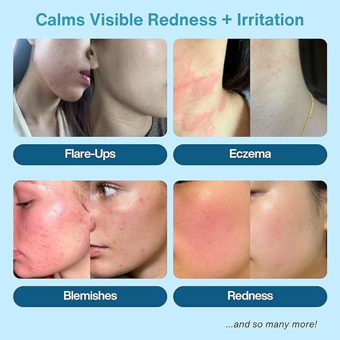 Hypochlorous Acid Spray – HOCl Face & Body Mist for Acne, Eczema & Irritation – Multi-Purpose Skin Repair – Eyelid Cleanser, Post-Workout/Procedure, Scalp & Sensitive Skin (2 oz+6.8 oz)-FemmiqueWomen