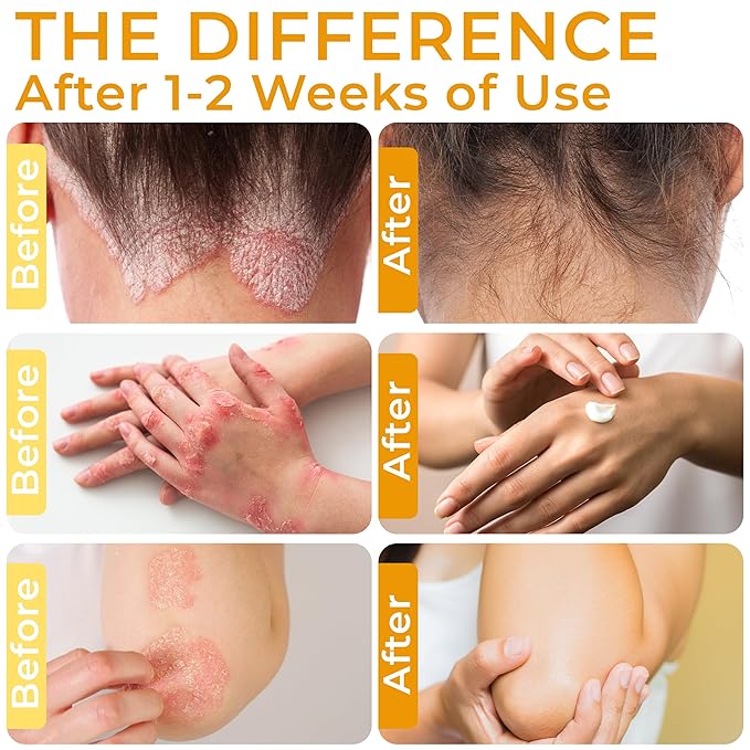 Psoriasis Cream for Itchy Scalp, Face & Body | Eczema Cream for Adults | Psoriasis Treatment for Skin | Itching, Irritation & Redness Relief | XL Size-FemmiqueWomen