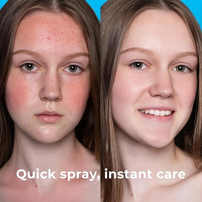 Hypochlorous Acid Spray (8oz, 2 packs), HOCL Facial Cleanser Acne Spray for Face, Body, Eczema, Pimples, Breakouts & Overall Skin Recovery (Reduces Redness)-FemmiqueWomen