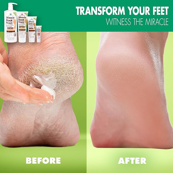Miracle Foot Repair Cream, 4 oz Repairs Dry Cracked Heels and Feet, Diabetic-Safe, 60% Pure Ultra Aloe Moisturizes, Softens, and Repairs, Relief from Discomfort of Ingrown Toenails (2-Pack)