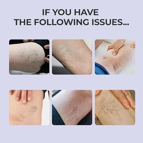 Soothing Leg Cream,Varicose Relief Cream,Cooling Gel For Varicose Veins Tr-eatment For Legs,Naturaly Plant-Based Ingredient 2pcs-FemmiqueWomen