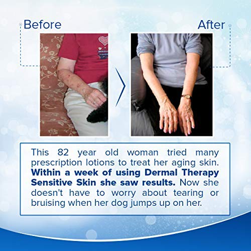 Dermal Therapy Sensitive Skin Lotion - Calming, Non-Irritating Lotion with 15% Allantoin, 10% Shea Butter, Vitamin E - Soothing Relief for Dry, Itchy, Eczema-Prone Skin - 8 fl oz / 240 ml-FemmiqueWomen