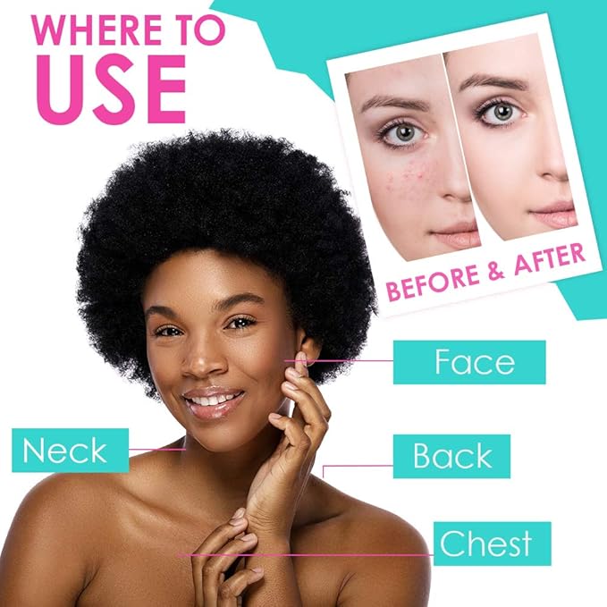 Bye Bye Blemish Acne Drying Lotion, Reduce Pimples Overnight, On-the-Spot Pimple Treatment, Beauty Skincare Essential - 1oz. (3 Pack)-FemmiqueWomen