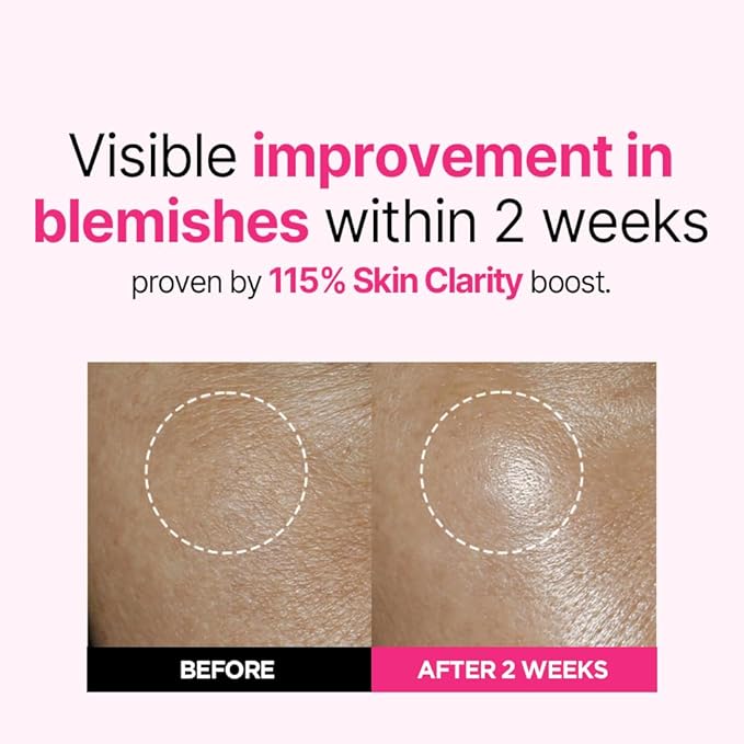 ISOI Blemish Care Up Serum for Face, Vegan Hydrating Serum for Smooth & Glass Skin Effect, Skin Barrier & Moisture Balance for Women, Korean Skin Care (0.85 fl. oz, 25ml)-FemmiqueWomen