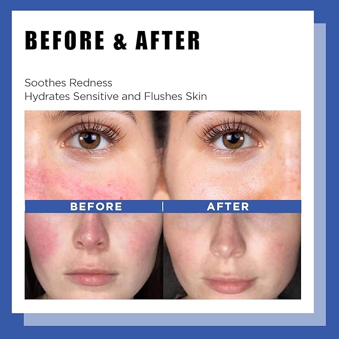 It'S SKIN LI Calming Skincare Set - Soothing Toner Pads, Ampoule Serum, Moisture Cream – Redness & Acne Relief with Licorice Extract & Guaiazulene – for Clear Skin-FemmiqueWomen