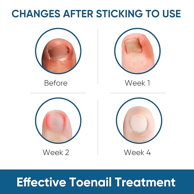 Ingrown Toenail Treatment, 60Pcs Ingrown Toenail Corrector Strips, Ingrown Toenail Removal Kit with File and Lifter, 60Pcs-FemmiqueWomen