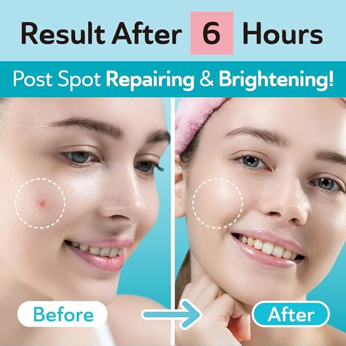 Invisible Pimple Patches for Cystic Acne - Ultra Thin Hydrocolloid Acne Patches & Zit Stickers, Cystic Acne Patch for Surface Blemishes - 48 Count - 2 Sizes Invisible Plus (Clear Patch)-FemmiqueWomen