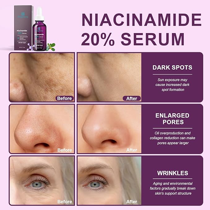 20% Niacinamide Serum for Face,Niacinamide Vitamin B3 B5 Concentrated Serum,Moisturizer,Pore Minimizer,Anti-aging Discoloration Correcting Treatment-FemmiqueWomen