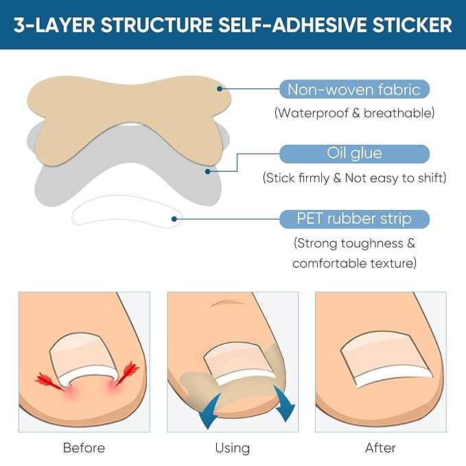 Ingrown Toenail Treatment, 60Pcs Ingrown Toenail Corrector Strips, Ingrown Toenail Removal Kit with File and Lifter, 60Pcs-FemmiqueWomen