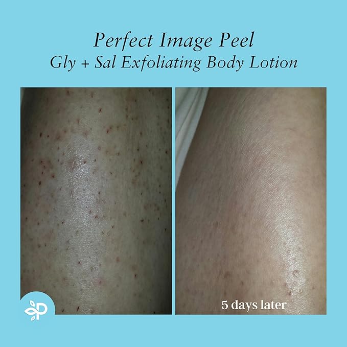 Perfect Image Gly + Sal Exfoliating Body Lotion, 8% Glycolic Acid and 2% Salicylic Acid Lotion Enhanced with Green Tea, Papaya, Bearberry, Licorice and Amino Complex-FemmiqueWomen