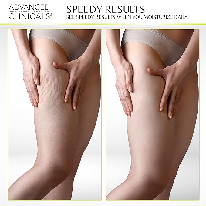 Advanced Clinicals Green Coffee Bean Thermo Firming Body Cream | Anti Cellulite Cream | Caffeine Body Lotion Moisturizer To Firm, Tighten, & Hydrate Look Of Legs, Arms, Tummy, Butt, & Thighs, 16 Oz-FemmiqueWomen