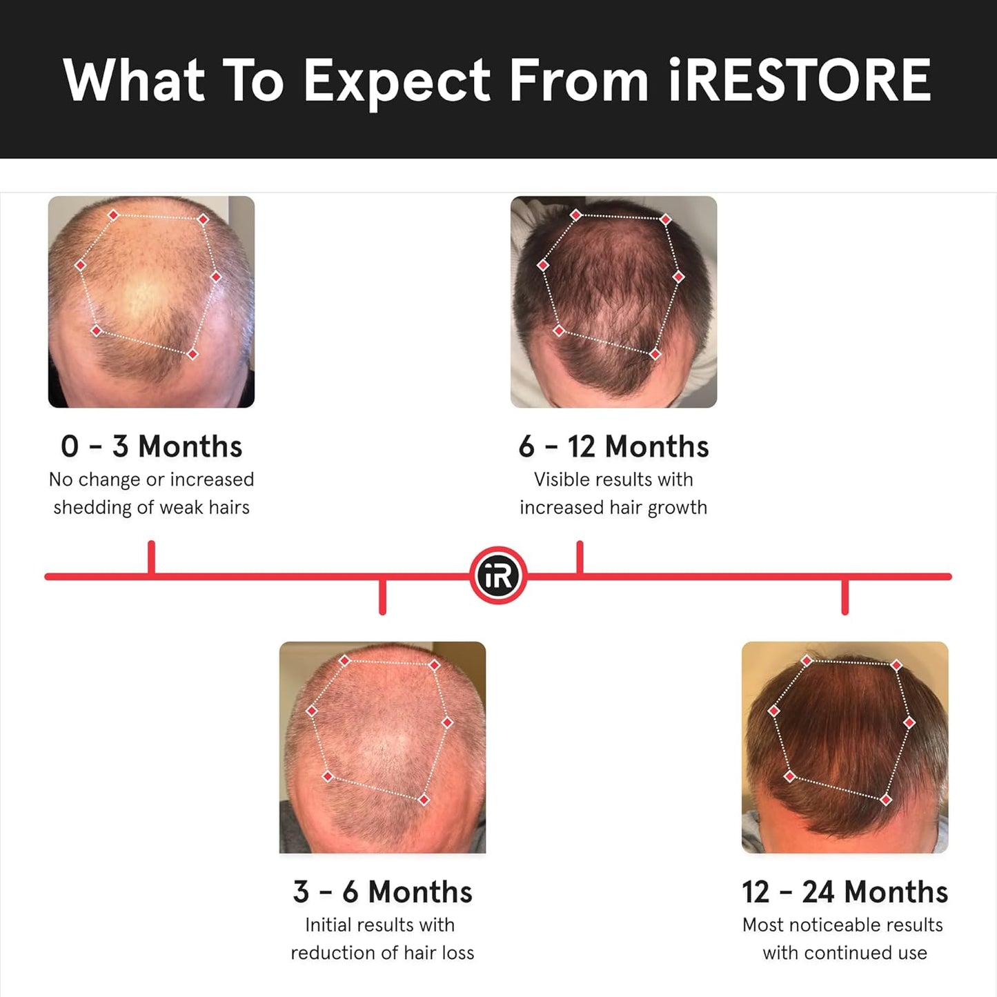 iRestore Essential - Laser Red Light Therapy for Hair Growth - FDA Cleared Hair Loss, Hair Thinning & Alopecia Treatment for Men & Women - Laser Cap for Hair Regrowth Stimulate Denser Fuller Hair-FemmiqueWomen