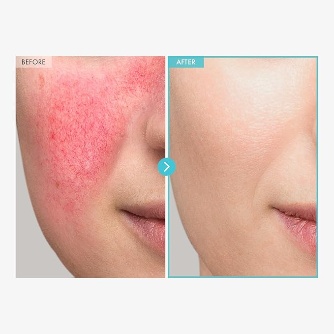 SOS Repair CICA Clinic Zinc Cream, 100,000ppm Zinc Oxide, Heal, Soothe Acne, Redness, Rosacea Treatment, Skin Barrier Repair, Moisture, Non-Comedogenic, Korean Skin care, 50g, 1.76 oz.-FemmiqueWomen