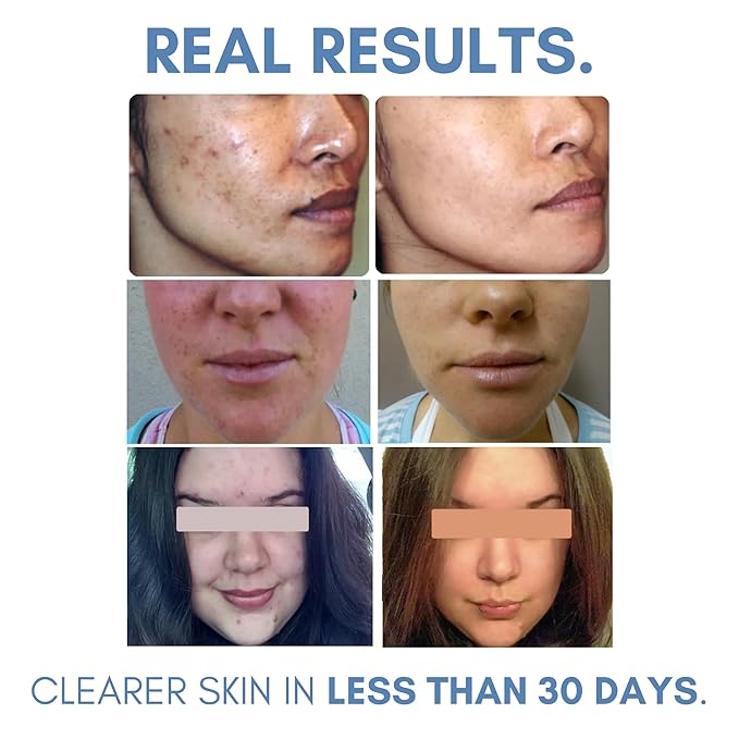 Clarifying Toner for Acne and Blemishes, Face Toner, Facial Toner, Skin Toner, Acne Toner, Toner Oily Skin, Salicylic Acid Toner, Astringent for Face, Toners, 4 Fl Oz-FemmiqueWomen