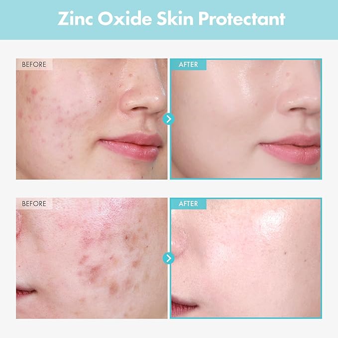 SOS Repair CICA Clinic Zinc Cream, 100,000ppm Zinc Oxide, Heal, Soothe Acne, Redness, Rosacea Treatment, Skin Barrier Repair, Moisture, Non-Comedogenic, Korean Skin care, 50g, 1.76 oz.-FemmiqueWomen