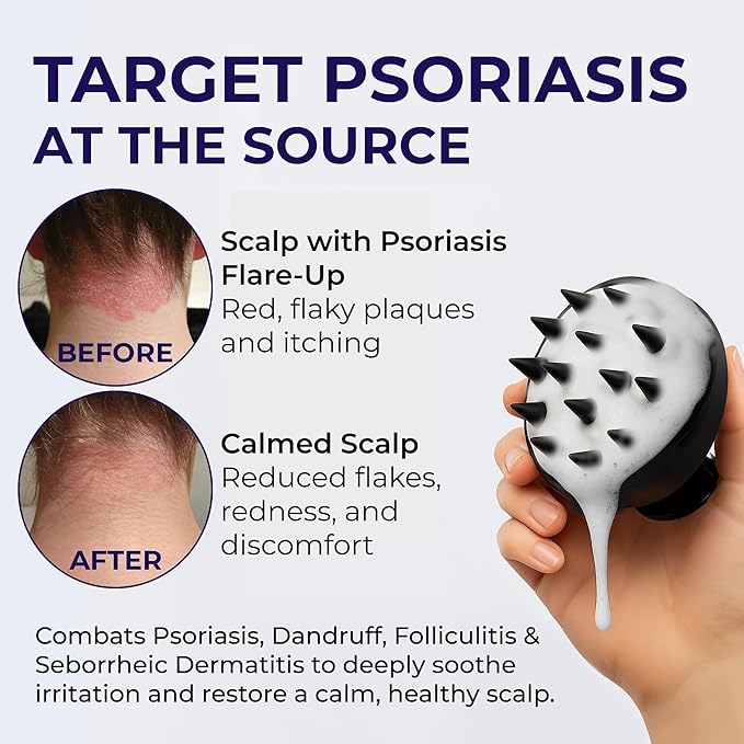 Scalp Psoriasis Shampoo, Flakes Shampoo Anti Dandruff, Itchy Scalp Treatment for Seborrheic Dermatitis & Folliculitis, Anti Fungal, Medicated Solution for Itchy, Flaky & Dry Hairs-FemmiqueWomen