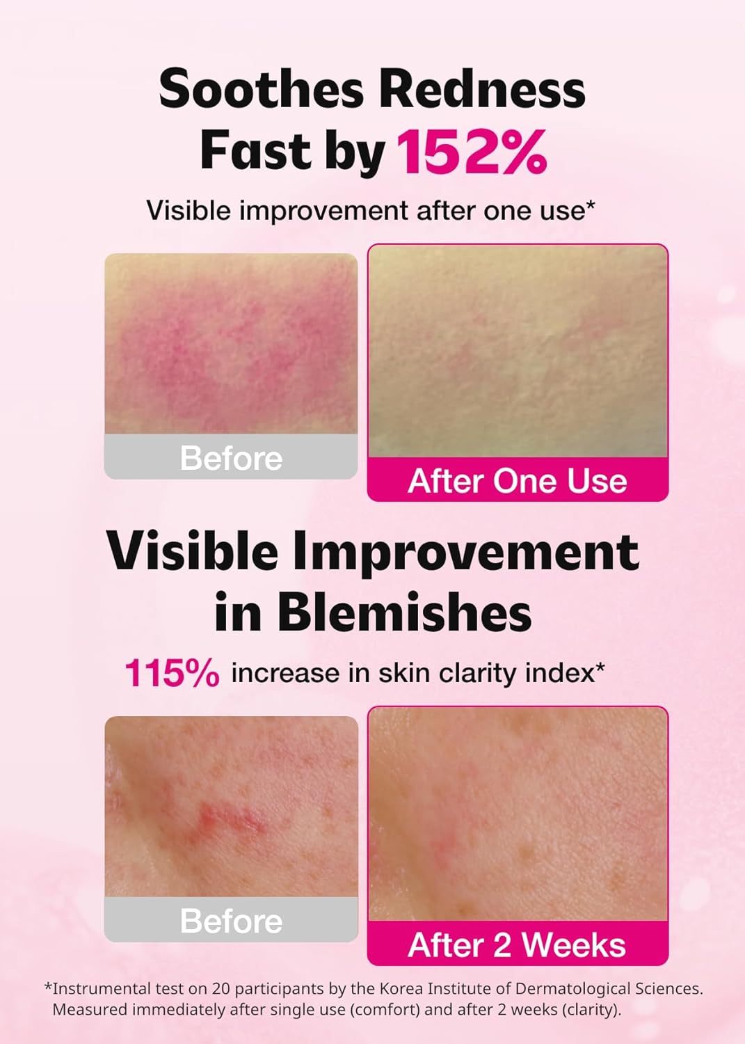 ISOI Blemish Care Up Serum for Face, Vegan Hydrating Serum for Smooth & Glass Skin Effect, Skin Barrier & Moisture Balance for Women, Arbutin, Korean Skin Care (1.18 fl. oz, 35ml)-FemmiqueWomen