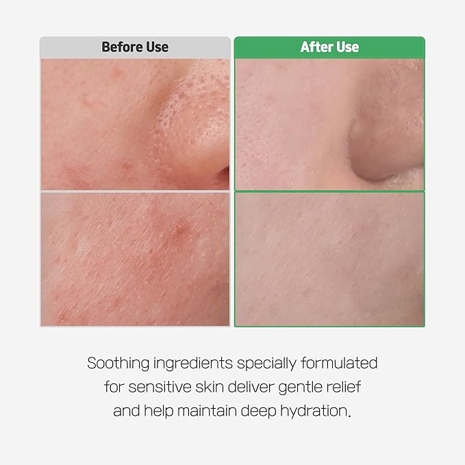 Cica Bio Spot Control Patch (1 Box, 62pcs) | Soothing Acne Patch for Redness & Blemishes | With Cica, Niacinamide & Tea Tree | Gentle for Sensitive Skin | Korean Skincare-FemmiqueWomen