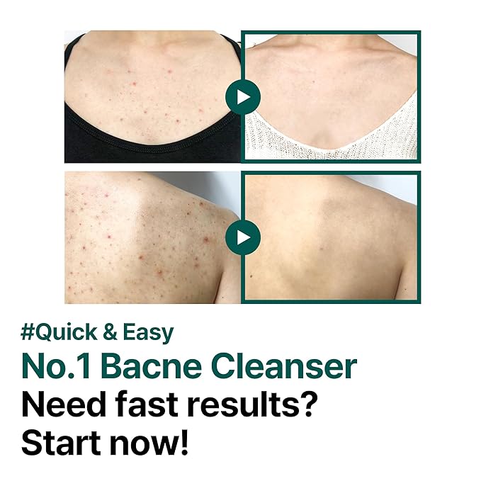 SOME BY MI AHA BHA PHA 30 Days Miracle Acne Clear Body Cleanser - Pack of 2 - Daily Exfoliating Tea Tree Acne Body Wash with Salicylic Acid - Deep Cleanses Sebum and Impurities - Korean Skin Care-FemmiqueWomen