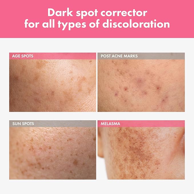 Arbutin 7% Intensive Spot Cream with 70,000ppm Arbutin, 3% Tranexamic Acid, 1% Niacinamide, Glutathione, Dark Spots, freckle, Blemishes, Anti-pigmentation, Korean Skin Care, 20ml, 0.67 fl.oz-FemmiqueWomen