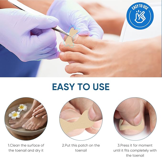 Ingrown Toenail Treatment, 60Pcs Ingrown Toenail Corrector Strips, Ingrown Toenail Removal Kit with File and Lifter, 60Pcs-FemmiqueWomen