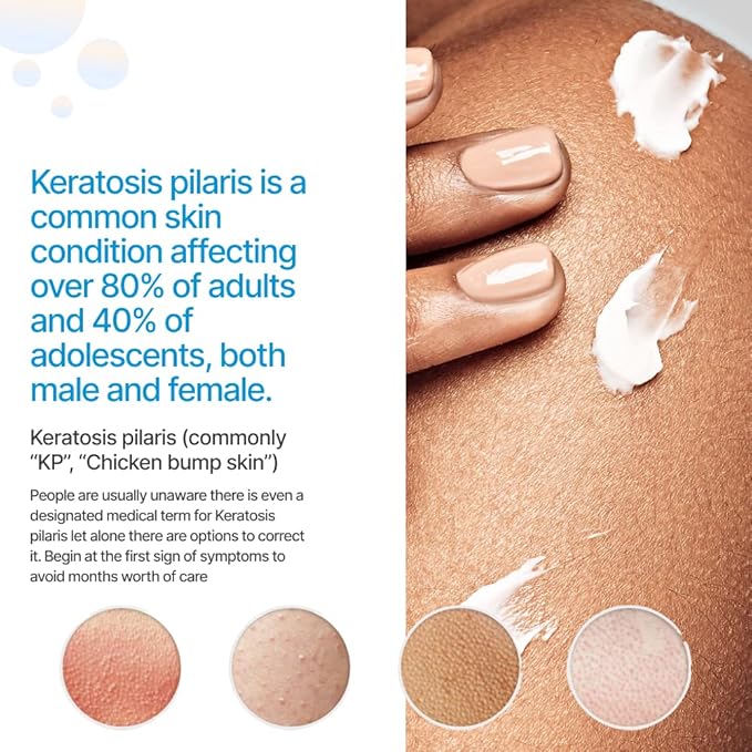 KP Essentials - Keratosis Pilaris Exfoliating Cream - Clear Red Bumps on Thighs and Arms For Confident Clear Skin - 4oz (1 Bottle)-FemmiqueWomen