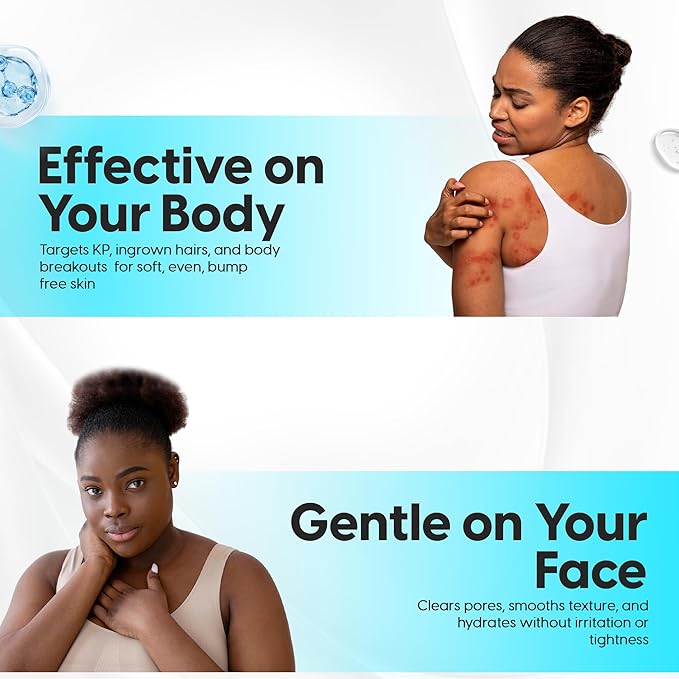 5% Lactic Acid + 2% Salicylic Acid Cleanser –Non-Stripping AHA/BHA Exfoliating Face & Body Wash With Ceramides. Minimizes Pores, Keratosis Pilaris, Acne, Ingrown Hairs & Psoriasis-200ml.-FemmiqueWomen