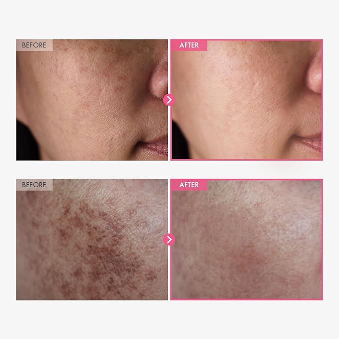 Arbutin 7% + Tranexamic Acid 4% Cream, 70,000ppm Arbutin, 40,000ppm TXA, Niacinamide, Glutathione, Dark Spots, Freckle, Blemishes, Pigmentation, Korean Skin Care, 50ml, 1.69 fl.oz.-FemmiqueWomen