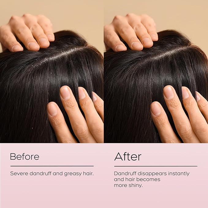 24HR Fast Itch Relief Anti-Fungal Shampoo for Psoriasis, Seborrheic Dermatitis & Folliculitis, Relieves Itchy, Dry Scalp, Sulfate & Paraben Free Anti-Dandruff Shampoo for Men and Women, 8.4 fl oz-FemmiqueWomen