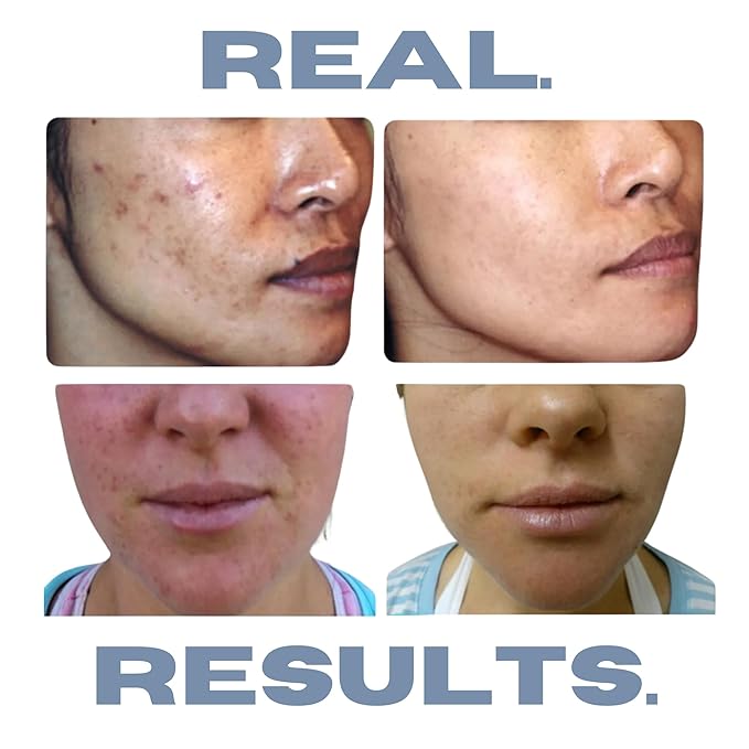 Clarifying Toner for Acne and Blemishes, Face Toner, Facial Toner, Skin Toner, Acne Toner, Toner Oily Skin, Salicylic Acid Toner, Astringent for Face, Toners, 4 Fl Oz-FemmiqueWomen