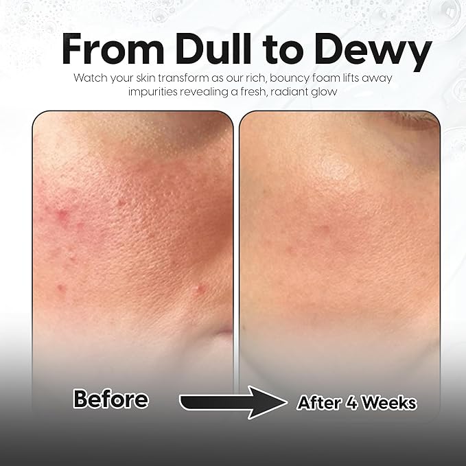 5% Lactic Acid + 2% Salicylic Acid Cleanser –Non-Stripping AHA/BHA Exfoliating Face & Body Wash With Ceramides. Minimizes Pores, Keratosis Pilaris, Acne, Ingrown Hairs & Psoriasis-200ml.-FemmiqueWomen