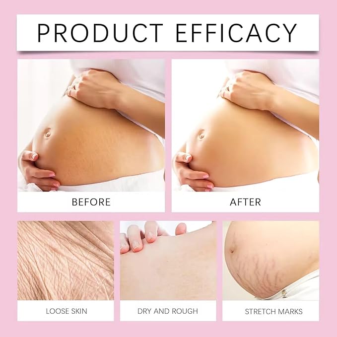 Stretch Mark Pregnancy Oil, Natural Oil Skincare Body Oil Serum for Scars and Stretch Marks, Face with Vitamin E & A for Sensitive Dry Skin and Body Moisturizer-FemmiqueWomen