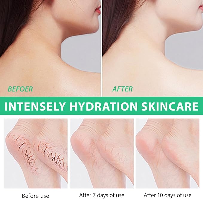 J&H Jasmine&Hyacinth 40% Urea Cream with 2% Salicylic Acid, Aloe, Feet/Heel Cream Moisturizer for Dry Cracked Heel, Knees, Elbows, Hands, Callus Remover, Intensive Hydrating Treatment-5.3 OZ/150 G-FemmiqueWomen