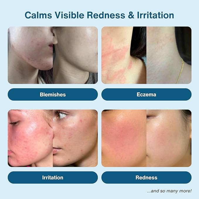 Hypochlorous Acid Spray – Eyelid Cleanser, HOCl Face & Skin Mist for Acne, Eczema & Irritation – Multi-Purpose Skin Repair – Post-Workout, Scalp & Sensitive Skin, Travel Size - 2 oz-FemmiqueWomen