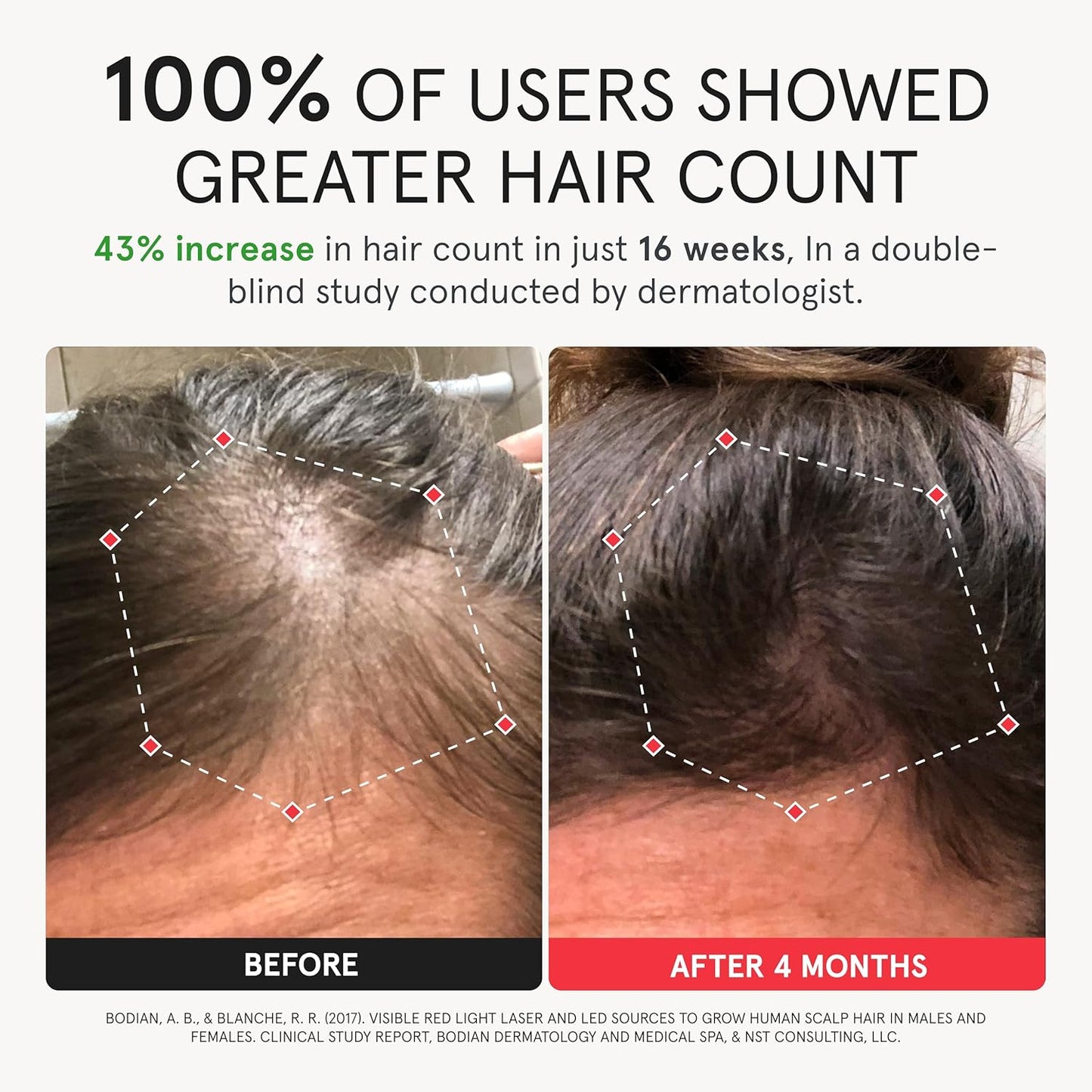 iRestore Elite - Laser Red Light Therapy for Hair Growth System - FDA Cleared Hair Loss, Hair Thinning & Alopecia Treatment for Men & Women - Laser Cap for Hair Regrowth Stimulates Denser Fuller Hair-FemmiqueWomen