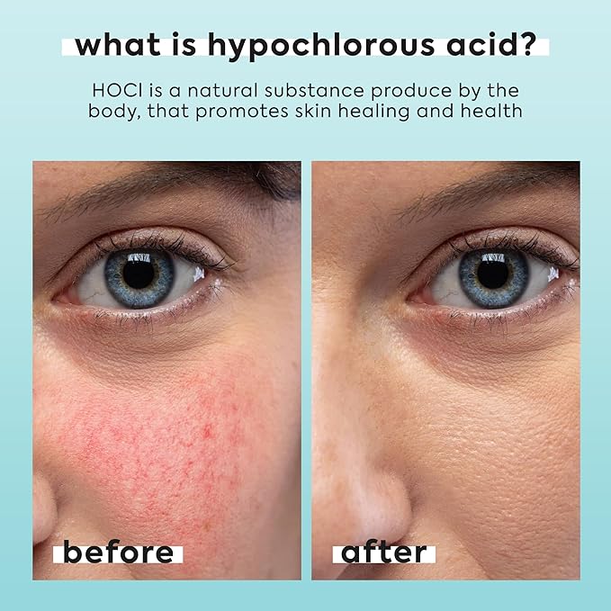 Hypochlorous Acid Spray for Face & Body - Helps Reduce Redness and Breakouts - Travel Size Hypochlorous Spray, Multi-Purpose Topical Facial Skin Repair, pH-Balancing Toner - TSA, Livaclean-FemmiqueWomen