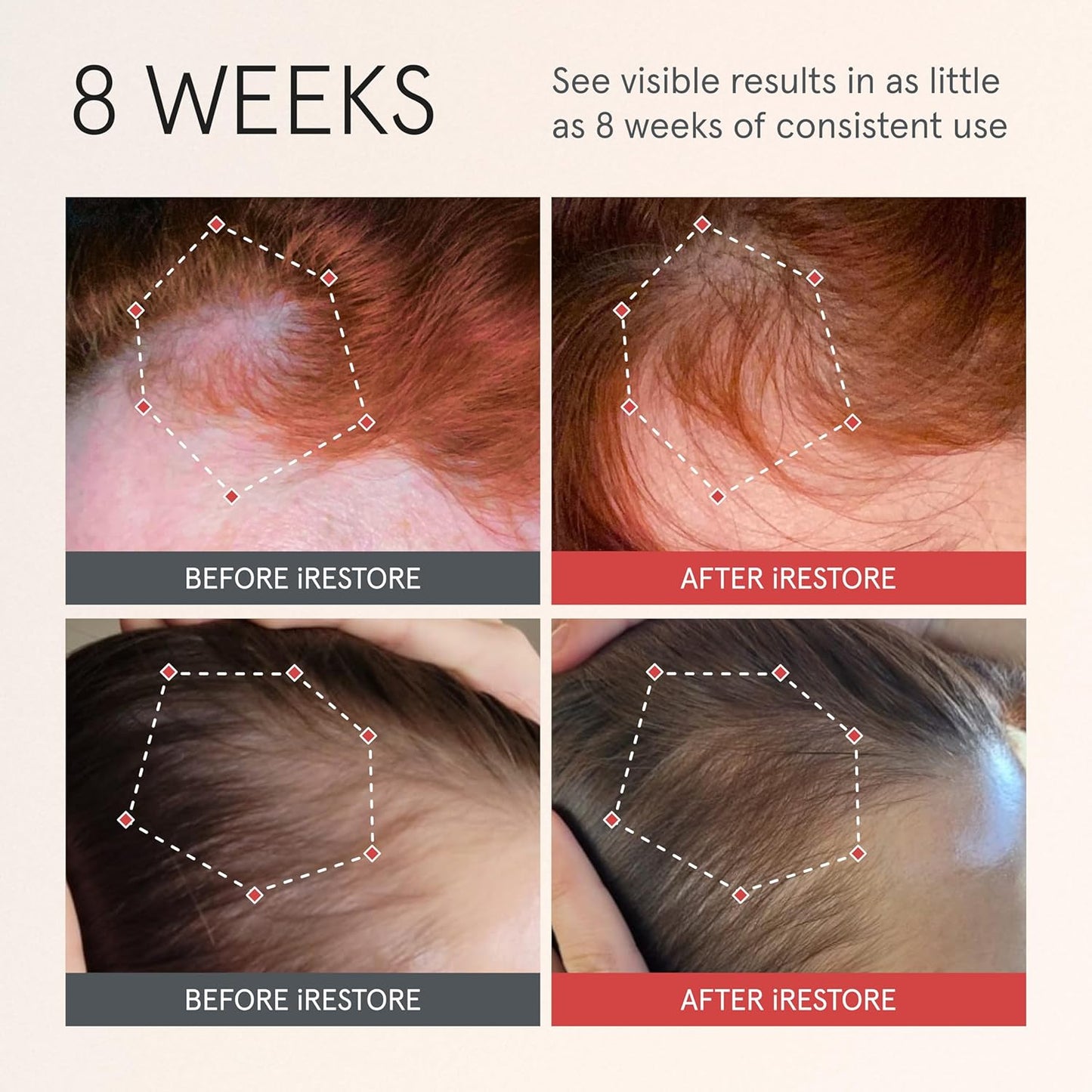 iRESTORE Scalp Serum | Hair Growth Serum for Women Men | Best for Hair Loss Hair Thinning | Aids Regrowth with Redensyl Capixyl & Biotin | Hydrates Scalp for Visibly Thicker Fuller Hair - 2 Fl Oz-FemmiqueWomen