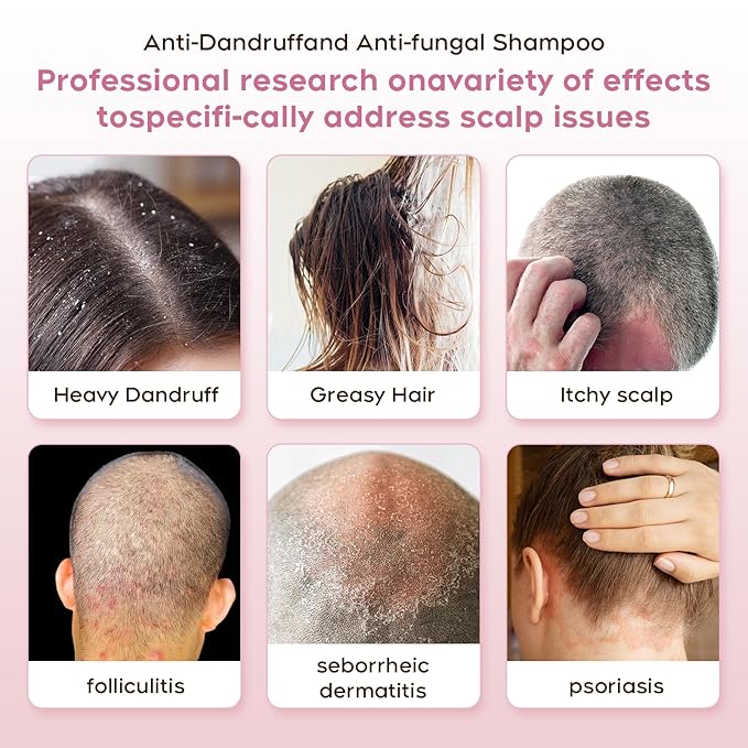24HR Fast Itch Relief Anti-Fungal Shampoo for Psoriasis, Seborrheic Dermatitis & Folliculitis, Relieves Itchy, Dry Scalp, Sulfate & Paraben Free Anti-Dandruff Shampoo for Men and Women, 8.4 fl oz-FemmiqueWomen