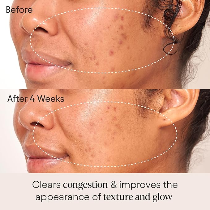 ALPYN Clarifying Facial Oil with Retinol & Pink Algae | Clear Congestion, Smooth Fine Lines, Improve Texture & Glow | 1 Fl Oz / 30 ml-FemmiqueWomen