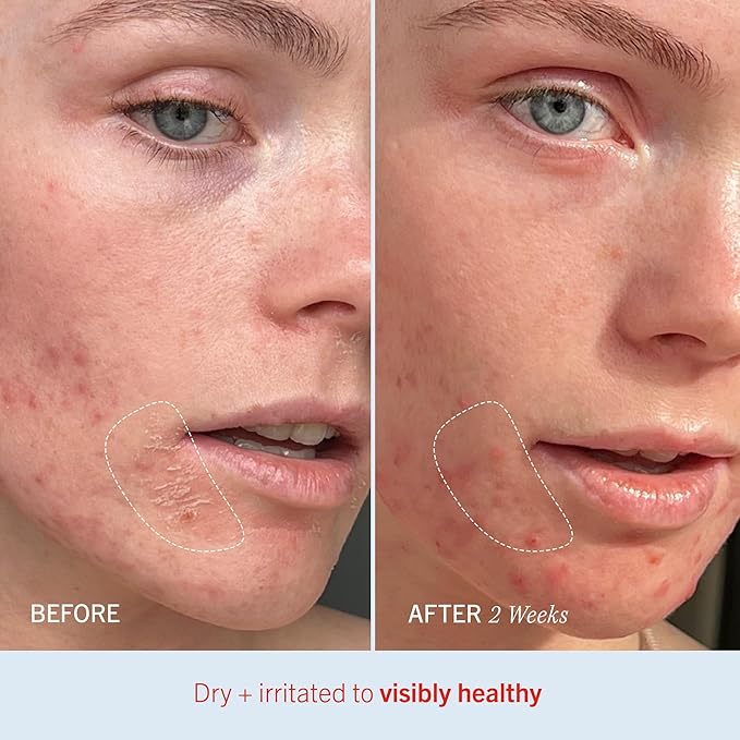 First Aid Beauty - Ultra Repair Cream, Intense Hydration Whipped Colloidal Oatmeal, Clinically Proven to Strengthen Skin Barrier in 7 Days & Helps Relieve Eczema, Luxury Face & Body Moisturizer, 8 oz-FemmiqueWomen