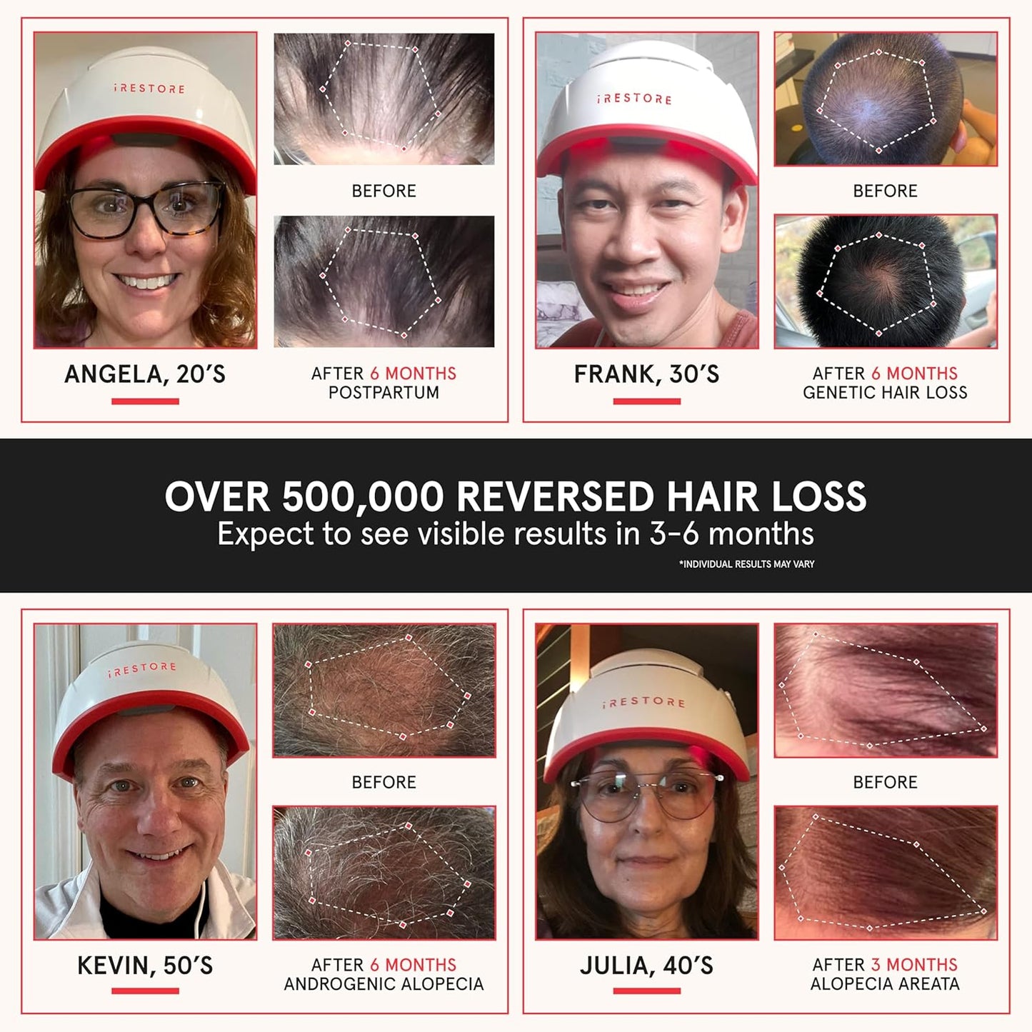 iRestore Professional Laser Red Light Therapy for Hair Growth System - FDA Cleared Hair Loss, Hair Thinning & Alopecia Treatment for Men & Women - 282 Lasers & LEDs-FemmiqueWomen
