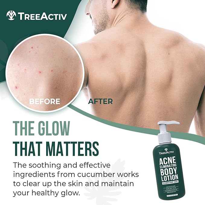 TreeActiv Acne Eliminating Body Lotion 8 fl oz | Clears Body, Back, Butt and Shoulder Acne | Anti-Acne Moisturizer | Prevents Future Breakouts | Cucumber Mint Scent-FemmiqueWomen