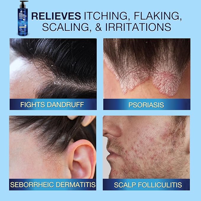 Anti-Fungal Shampoo for Scalp Psoriasis: Dandruff Shampoo for Folliculitis and Seborrheic Dermatitis - Relieves Itchy & Dry Scalp - 300 mL / 10.1 fl.oz-FemmiqueWomen