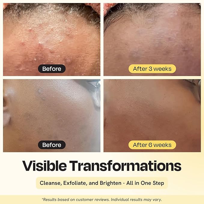 Gleamin Vitamin C Face Wash & Facial Cleanser - Cream to Foam 2% Salicylic Acid Cleanser with Paw Paw & Turmeric - Gentle Exfoliating Facewash for Women & Men, Oily & Combination Skin, 3.4 fl oz-FemmiqueWomen