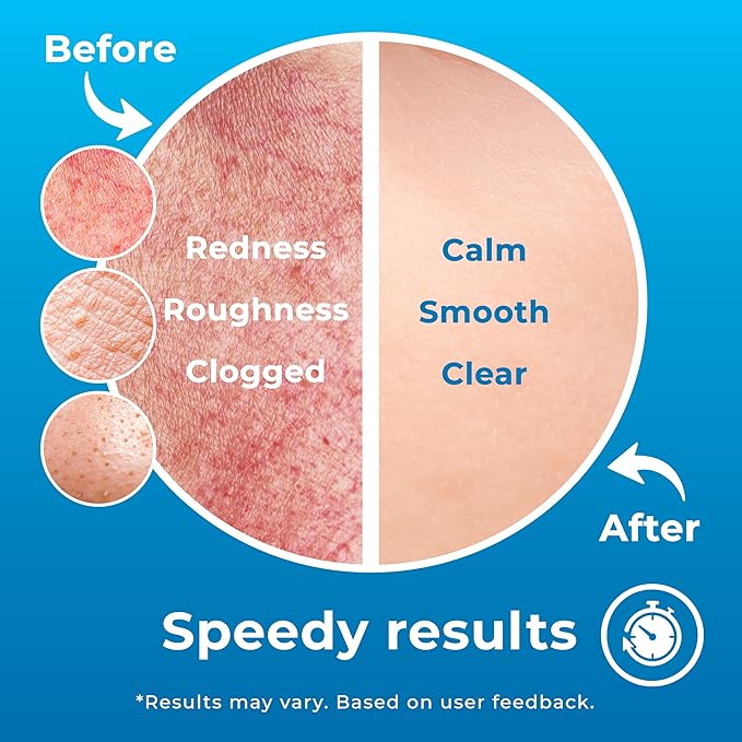 Hypochlorous Acid Spray (8oz, 2 packs), HOCL Facial Cleanser Acne Spray for Face, Body, Eczema, Pimples, Breakouts & Overall Skin Recovery (Reduces Redness)-FemmiqueWomen